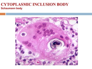 CYTOPLASMIC INCLUSION BODY
Schaumann body
 