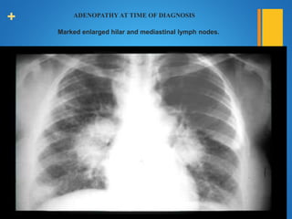 + ADENOPATHY AT TIME OF DIAGNOSIS
Marked enlarged hilar and mediastinal lymph nodes.
 
