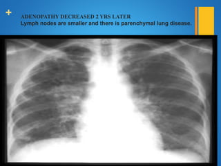 + ADENOPATHY DECREASED 2 YRS LATER
Lymph nodes are smaller and there is parenchymal lung disease.
 