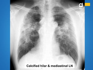 Calcified hilar & mediastinal LN
 