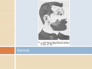 Sarcoid
 