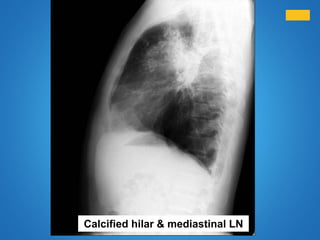 Calcified hilar & mediastinal LN
 