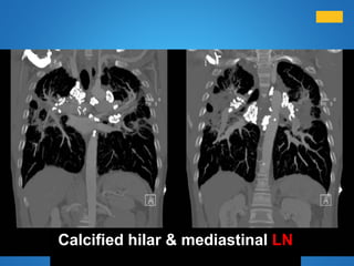 Calcified hilar & mediastinal LN
 