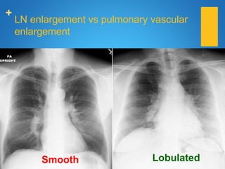 +
LN enlargement vs pulmonary vascular
enlargement
LobulatedSmooth
 