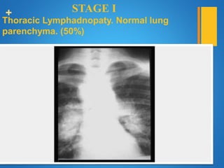 + STAGE I
Thoracic Lymphadnopaty. Normal lung
parenchyma. (50%)
 