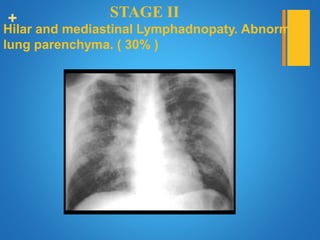 + STAGE II
Hilar and mediastinal Lymphadnopaty. Abnormal
lung parenchyma. ( 30% )
 