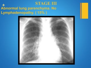 + STAGE III
Abnormal lung parenchyma. No
Lymphadenopathy. ( 15% )
 