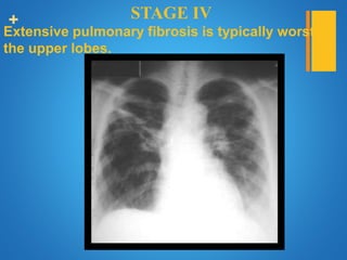 + STAGE IV
Extensive pulmonary fibrosis is typically worst in
the upper lobes.
 