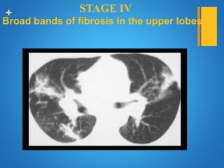 + STAGE IV
Broad bands of fibrosis in the upper lobes
 