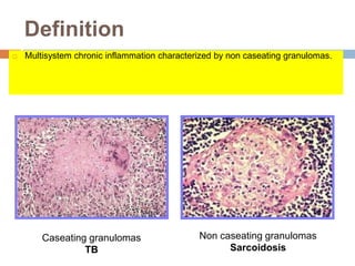Definition
 Multisystem chronic inflammation characterized by non caseating granulomas.
Caseating granulomas
TB
Non caseating granulomas
Sarcoidosis
 