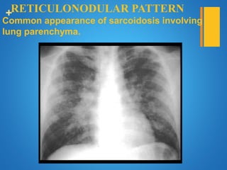 +RETICULONODULAR PATTERN
Common appearance of sarcoidosis involving the
lung parenchyma.
 