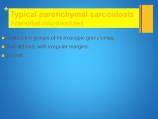 +
Typical parenchymal sarcoidosis
Interstitial micronodules
 Coalescent groups of microscopic granulomas.
 Well defined, with irregular margins.
 2-4 mm.
 