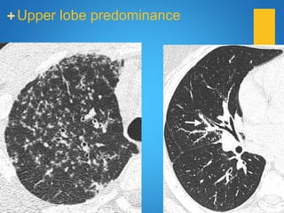 +Upper lobe predominance
 