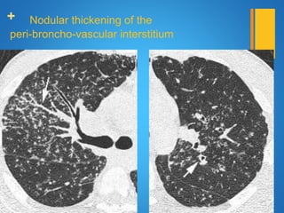 + Nodular thickening of the
peri-broncho-vascular interstitium
 
