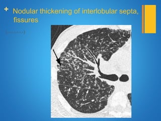 + Nodular thickening of interlobular septa,
fissures
(.-.-.-.-.-.-)
 