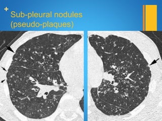 +
Sub-pleural nodules
(pseudo-plaques)
 