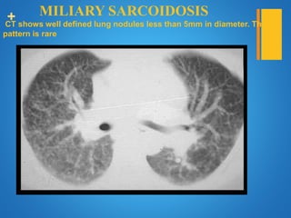 + MILIARY SARCOIDOSIS
CT shows well defined lung nodules less than 5mm in diameter. This
pattern is rare
 