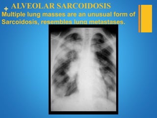 + ALVEOLAR SARCOIDOSIS
Multiple lung masses are an unusual form of
Sarcoidosis, resembles lung metastases.
 