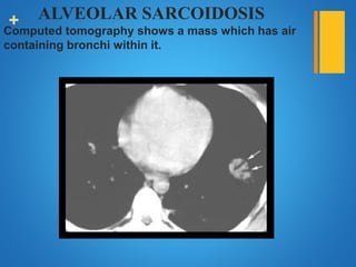 + ALVEOLAR SARCOIDOSIS
Computed tomography shows a mass which has air
containing bronchi within it.
 