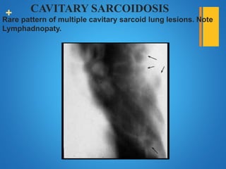 + CAVITARY SARCOIDOSIS
Rare pattern of multiple cavitary sarcoid lung lesions. Note
Lymphadnopaty.
 