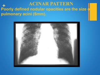 + ACINAR PATTERN
Poorly defined nodular opacities are the size of
pulmonary acini (6mm).
 