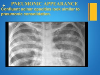 + PNEUMONIC APPEARANCE
Confluent acinar opacities look similar to
pneumonic consolidation.
 