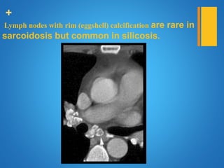 +
Lymph nodes with rim (eggshell) calcification are rare in
sarcoidosis but common in silicosis.
 