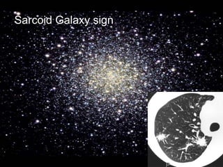 +
Sarcoid Galaxy sign
 