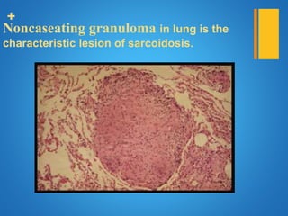 +
Noncaseating granuloma in lung is the
characteristic lesion of sarcoidosis.
 