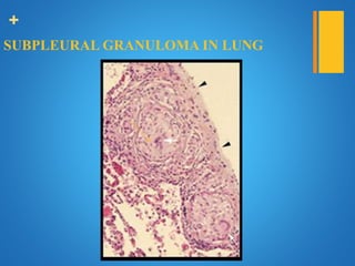+
SUBPLEURAL GRANULOMA IN LUNG
 