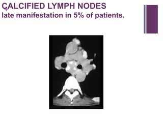 +CALCIFIED LYMPH NODES
late manifestation in 5% of patients.
 