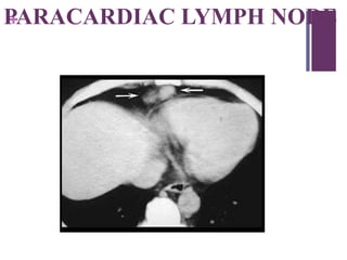 +PARACARDIAC LYMPH NODE
 