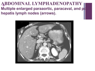 +ABDOMINAL LYMPHADENOPATHY
Multiple enlarged paraaortic, paracaval, and porta
hepatis lymph nodes (arrows).
 