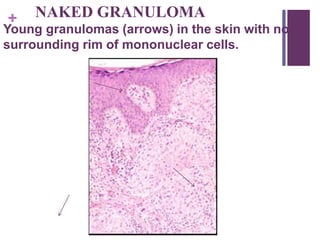 + NAKED GRANULOMA
Young granulomas (arrows) in the skin with no
surrounding rim of mononuclear cells.
 