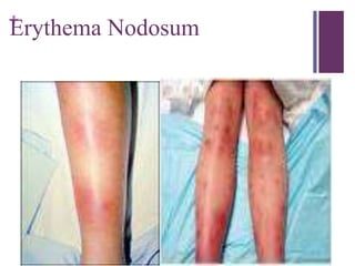 +
Erythema Nodosum
 
