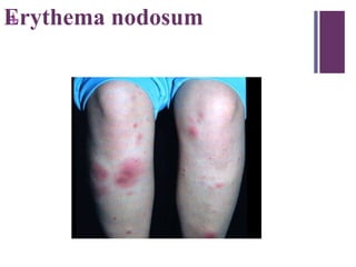 +Erythema nodosum
 