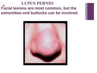+
LUPUS PERNIO
Facial lesions are most common, but the
extremities and buttocks can be involved.
 