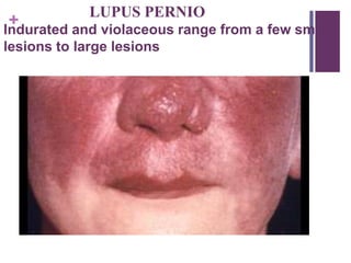 +
LUPUS PERNIO
Indurated and violaceous range from a few small
lesions to large lesions
 