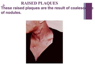 +
RAISED PLAQUES
These raised plaques are the result of coalescence
of nodules.
 