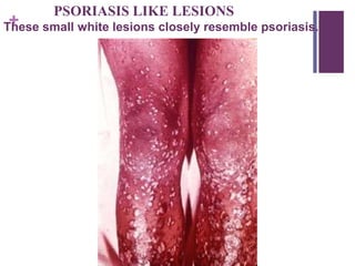 +
PSORIASIS LIKE LESIONS
These small white lesions closely resemble psoriasis.
 