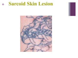 + Sarcoid Skin Lesion
 