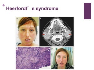 +
Heerfordt’s syndrome
 