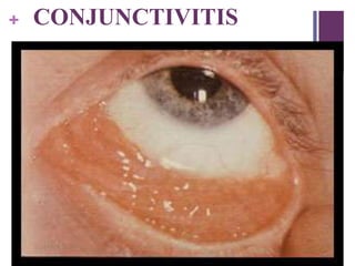 + CONJUNCTIVITIS
 