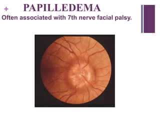 + PAPILLEDEMA
Often associated with 7th nerve facial palsy.
 