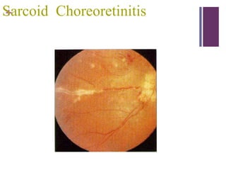 +Sarcoid Choreoretinitis
 