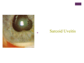 + Sarcoid Uveitis
 