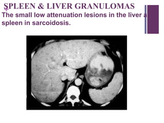 +SPLEEN & LIVER GRANULOMAS
The small low attenuation lesions in the liver and
spleen in sarcoidosis.
 