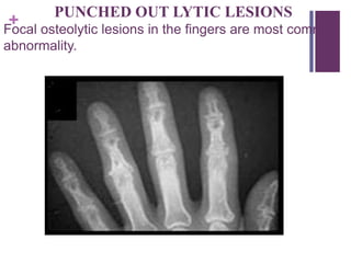 +
PUNCHED OUT LYTIC LESIONS
Focal osteolytic lesions in the fingers are most common
abnormality.
 