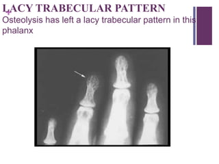 +LACY TRABECULAR PATTERN
Osteolysis has left a lacy trabecular pattern in this
phalanx
 