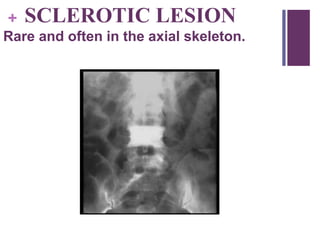 + SCLEROTIC LESION
Rare and often in the axial skeleton.
 